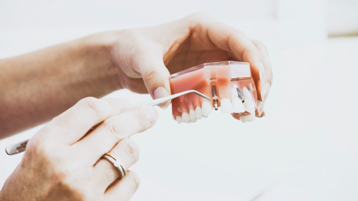Zobni vsadki zahtevajo temeljito ustno higieno
